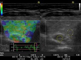 Real Time Elastography