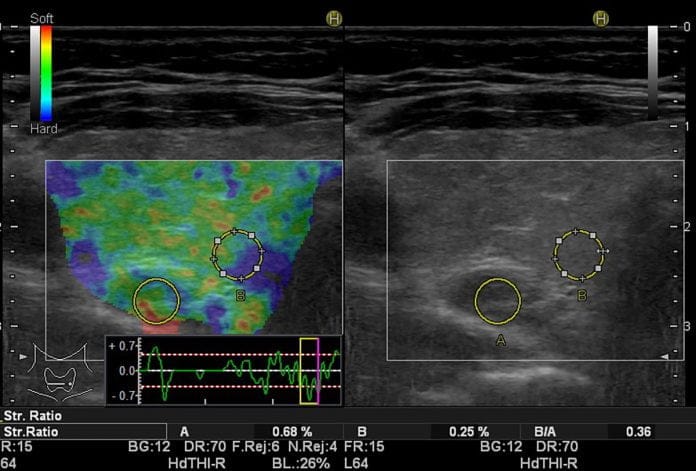 Real Time Elastography